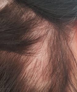 what is traction alopecia